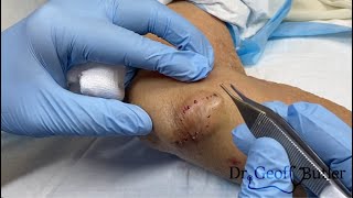 Removal of a fairly large epidermal cyst on the elbow [upl. by Lapides414]