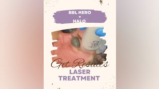 BBL Hero  Halo Sciton laser treatment combo up close progress photos and results included [upl. by Loraine492]