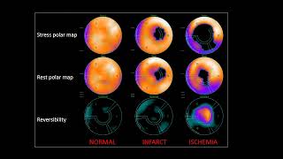 Nucradsharewordpresscom HOW TO READ MYOCARDIAL PERFUSION SCAN [upl. by Eylsel]