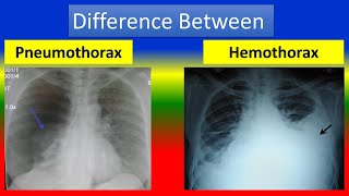 Difference between Pneumothorax and Hemothorax [upl. by Daryl]