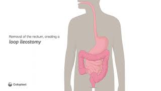 Creation of loop ileostomy by removing the rectum  Ostomy surgery  Coloplast India [upl. by Leela]