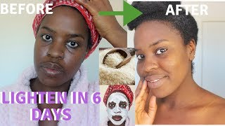 How I How i BRIGHTENED MY SKIN IN 6 DAYS REALISTIC and Natural way to reduce hyperpigmentation [upl. by Yerffoj]