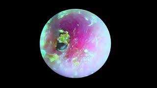 Cleaning of external auditory canal fungal cerumen embolism [upl. by Aniram]