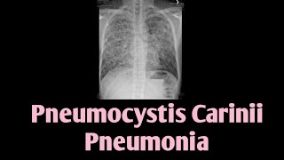 Pneumocystis Carinii Pneumonia  PCP  Pneumocystis Jirovecii [upl. by Eittol]