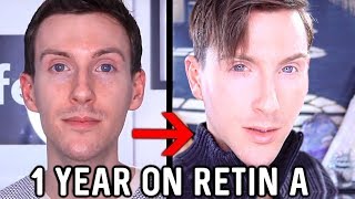 MY 1 YEAR RETINA RESULTS  BEFORE AND AFTER TRETINOIN [upl. by Brittain]