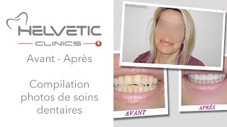 Avant Après  Compilation photos de soins dentaires [upl. by Austine]