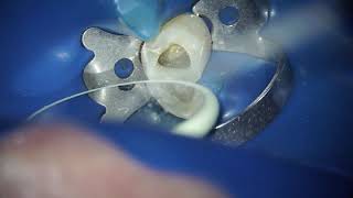 Root canal treatment  dentist teeth dentistry dentalclinic dental cavity tooth [upl. by Traver]