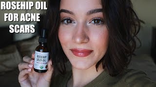 TRYING ROSEHIP OIL FOR A MONTH FOR ACNE SCARS [upl. by Lurie]