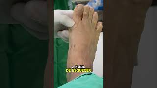 Joanete na Cirurgia Percutânea joanete halluxvalgus bunions bunion [upl. by Nnylcaj176]