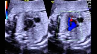 Tetralogy of Fallot with pulmonary stenosis 3 vessel tracheal view [upl. by Lsil]