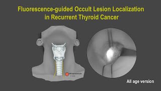 All age  Fluorescence guided Occult Lesion Localization in recurrent thyroid cancer [upl. by Llerret]