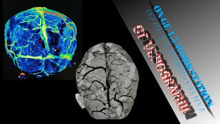 CT BRAIN VENOGRAPHY ON GE WORKSTATION 45 MAKE EASLY 🙂 [upl. by Frolick]