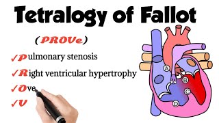 Tetralogy Of Fallot [upl. by Danyette431]