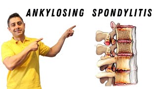 Ankylosing Spondylitis core exercises [upl. by Dionysus]