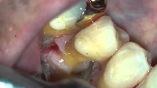 Surgical Resorption Repair [upl. by Einor]