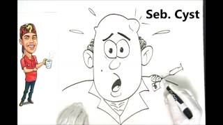 Sebaceous Cyst Explained Simply [upl. by Ahcorb]