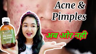 Remove ACNEPIMPLES At Home ACNE Treatment At Home How To Use GOMUTRA For CYSTIC And HORMONAL ACNE [upl. by Gilberta]