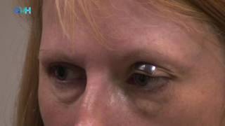 Using External Eyelid Weights In Facial Nerve Palsy [upl. by Chatav262]