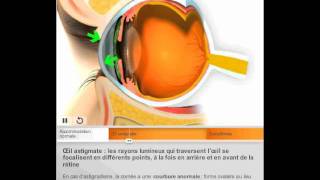 Lastigmatisme par Quantel Medical [upl. by Oad]