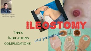 What is an ileostomy Typesindications and complications case presentation [upl. by Htebirol]