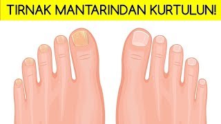 TIRNAK MANTARINDAN KURTULMANIN 5 DOĞAL YÖNTEMİ [upl. by Utir]