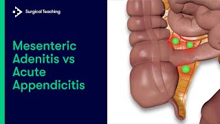 Mesenteric Adenitis vs Appendicitis  How to tell the difference [upl. by Luehrmann336]