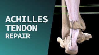 Achilles Tendon Repair [upl. by Willner]