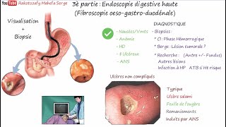 ULCÈRES GASTRIQUE ET DUODÉNAL  3è Partie  Endoscopie digestive haute FOGD [upl. by Arlana]