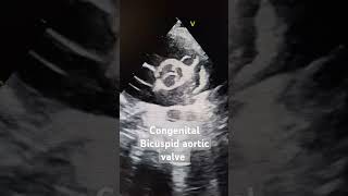 Bicuspid Aortic Valve echo echocardiography congenitalheartdisease aortic Bicuspid [upl. by Currie869]