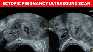 Ectopic Pregnancy Ultrasound Scan  Dr Kunal Rathod [upl. by Jaquiss]