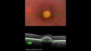 Vitelliform Dystrophy  Multimodal Imaging Analysis [upl. by Moriarty]