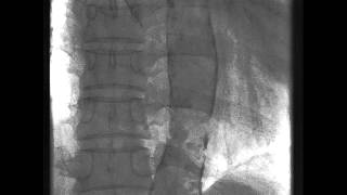 Dense Calcification in the Aorta [upl. by Cirederf]