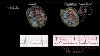 Fibrillation auriculaire  Définition  Impact  Evaluation  Anticoag  HH  FC  Rythme [upl. by Etna]