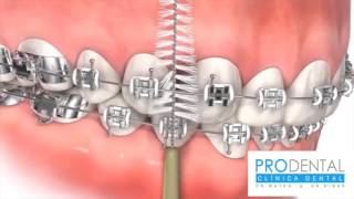 ¿Cómo lavarse correctamente los dientes con brackets [upl. by Ynot437]