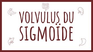 Sémiologie Chirurgicale  Volvulus du Sigmoïde [upl. by Lig121]