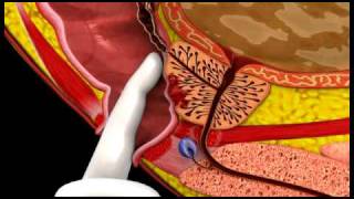 Prostate Cancer  3D Medical Animation  ABP © [upl. by Nalon]