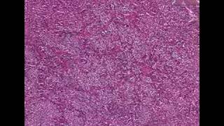 Histopathology PituitaryAcidophilic adenoma [upl. by Durand]