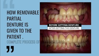 REMOVABLE PARTIAL DENTURE COMPLETE PATIENT PROCESS [upl. by Asseret]