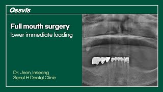 Clinical Case Full mouth surgery lower immediate loading [upl. by Eduj]