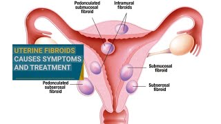 Uterine Fibroids Symptoms and Treatment How to shrink Fibroids Naturally [upl. by Edmanda]