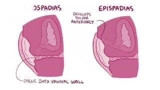 Hypospadias amp epispadias causes symptoms diagnosis treatment pathology [upl. by Aihsekat]