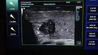 Papillary Thyroid Cancer Ultrasound [upl. by Darnell328]