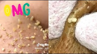 Ultimate Satisfying Pimple Popping Compilation 2024  Best Blackhead amp Acne Removal Videos [upl. by Corel]