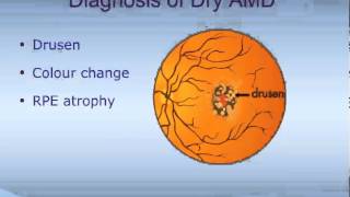 Dry AgeRelated Macular Degeneration Dry AMD [upl. by Franzoni]