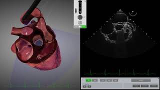 HeartWorks Mechanical Aortic Valve [upl. by Pump959]