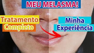 MELASMA Como tratar clarear e prevenir o melasma mancha escura na pele Minha Experiência [upl. by Byrn]