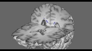 Soccer heading and the brains gray matterwhite matter interface [upl. by Benn]