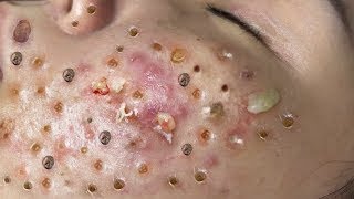 Relaxing Acne Treatment Acnes Treatment 74 [upl. by Atoiyanap]