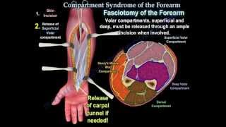 Compartment Syndrome Of The Forearm  Everything You Need To Know  Dr Nabil Ebraheim [upl. by Andriette488]