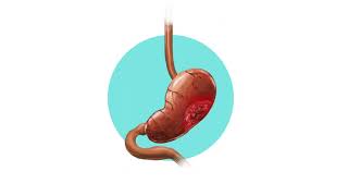 Gastritis Crónica con Metaplasia Intestinal [upl. by Icaj]